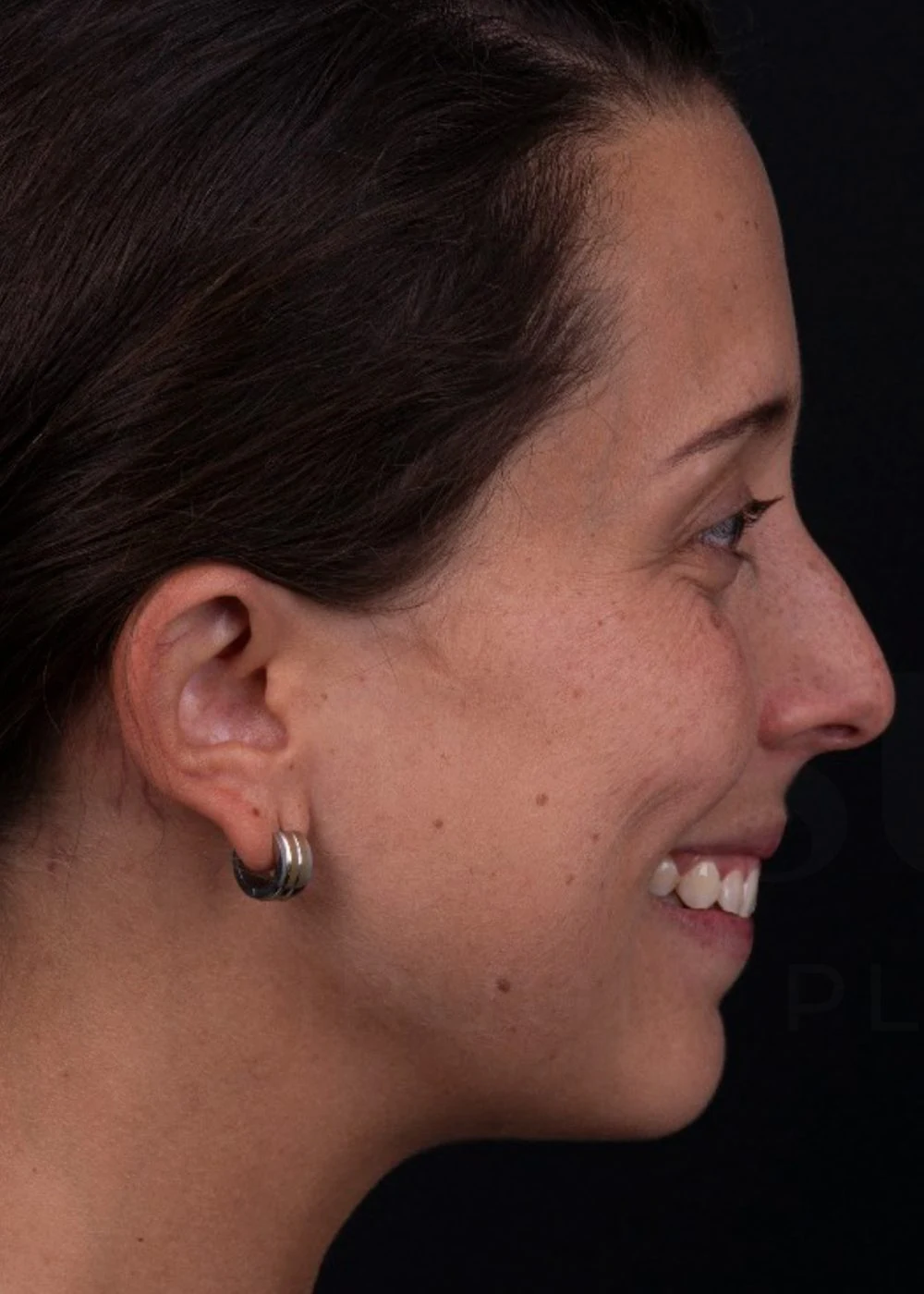 Antes: rinoplastia preservadora de dorso, perfil
