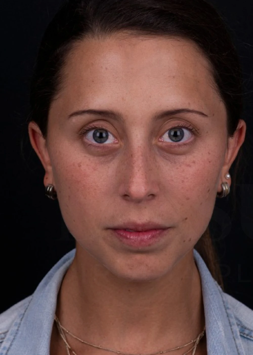 Antes: rinoplastia preservadora de dorso, frontal