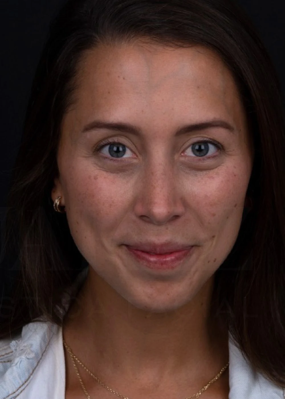 Después: rinoplastia preservadora de dorso, frontal