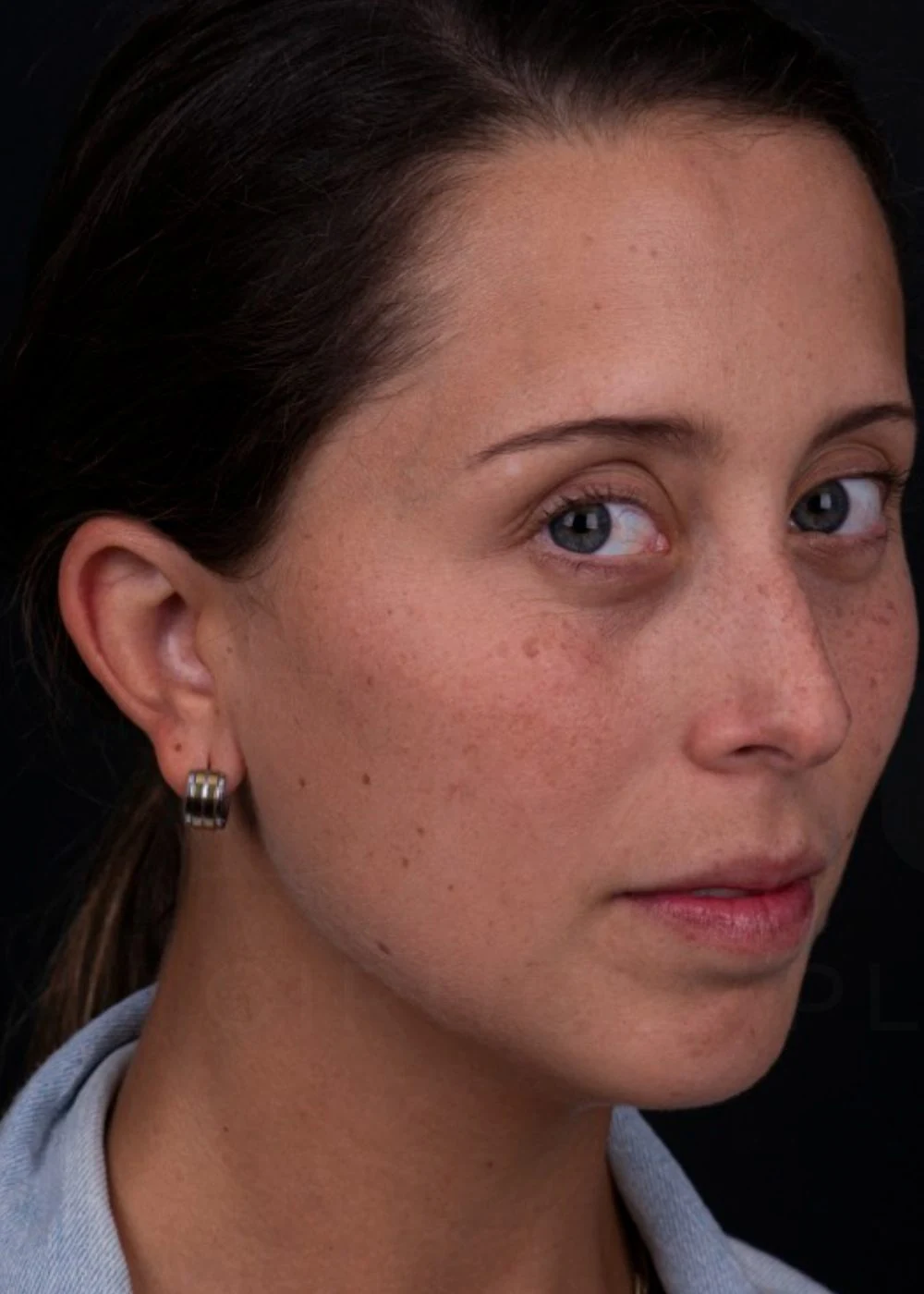 Antes: rinoplastia preservadora de dorso, tres cuartos
