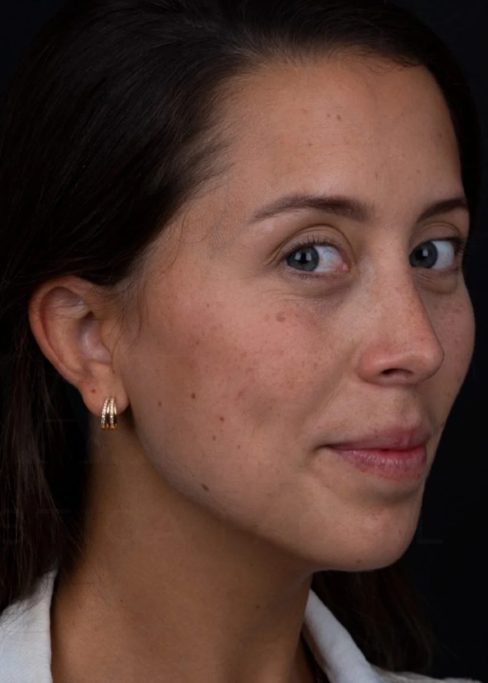 Después: rinoplastia preservadora de dorso, tres cuartos